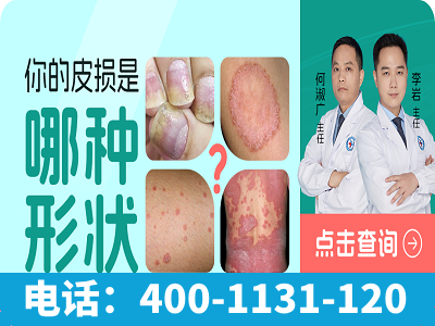 苏州银屑病治疗哪个医院有效